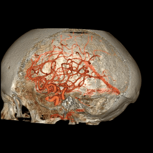Czaszka i koło tętnicze mózgu zaopatrujące mózg w krew. Fot. GE Healthcare