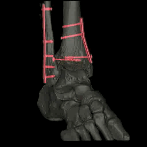 Kostka i stopa po złamaniu wzmocnione płytkami i śrubami. Fot GE Healthcare