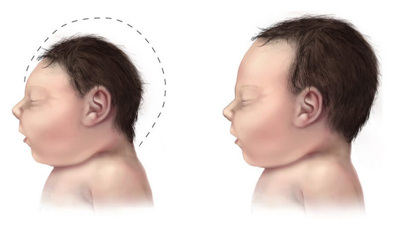 Porównanie głowy dziecka z mikrocefalią z głową zdrowego dziecka. Rys. CDC