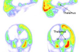 Wyniki skanowania PET mózgu pacjenta. Po lewej stan przed stymulacją, po prawej - w 3 miesiące po rozpoczęciu stymulacji. Fot. Corazzol and Lio et al., Current Biology (2017)